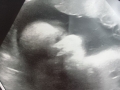 matix ultrasound