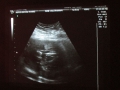 matix ultrasound2