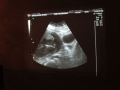 matix ultrasound3