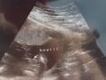 matix ultrasound1